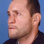 Rhinoplasty Before & After Patient #1098