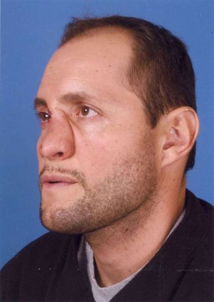 Rhinoplasty Before & After Patient #1098