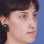 Rhinoplasty Before & After Patient #1083