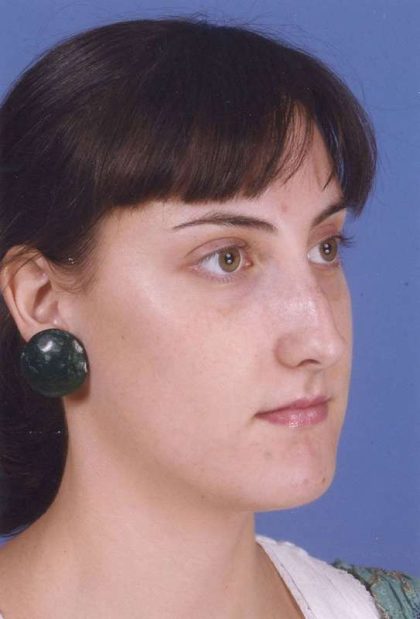 Rhinoplasty Before & After Patient #1083