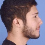 Rhinoplasty Before & After Patient #1071