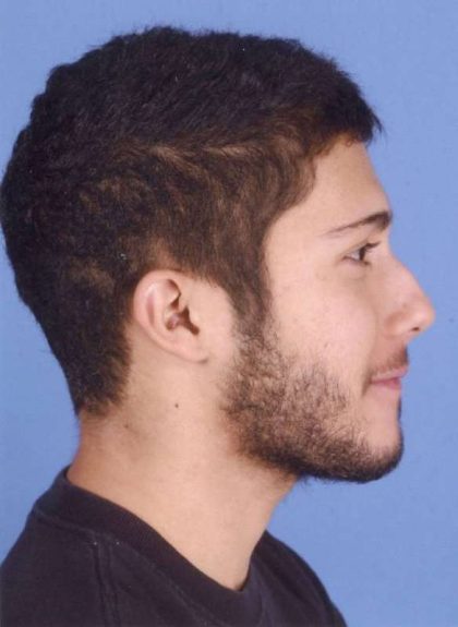 Rhinoplasty Before & After Patient #1071