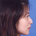Rhinoplasty Before & After Patient #1065