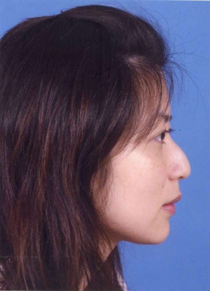 Rhinoplasty Before & After Patient #1065