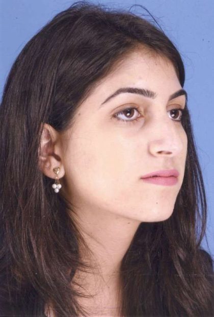 Rhinoplasty Before & After Patient #1059