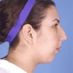 Rhinoplasty Before & After Patient #1044