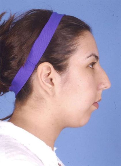 Rhinoplasty Before & After Patient #1044