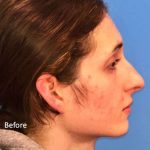 Rhinoplasty Before & After Patient #1038