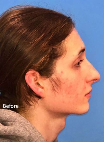 Rhinoplasty Before & After Patient #1038
