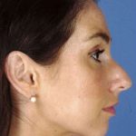 Rhinoplasty Before & After Patient #1032
