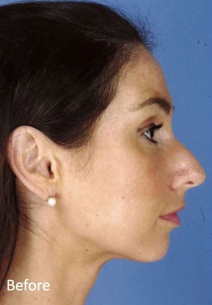 Rhinoplasty Before & After Patient #1032
