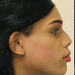 Facial Feminization Before & After Patient #906
