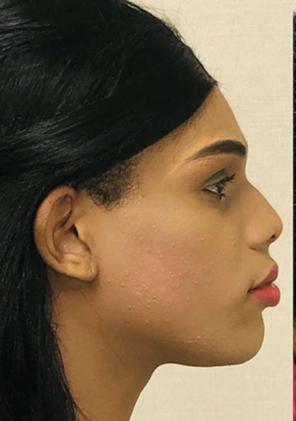 Facial Feminization Before & After Patient #906