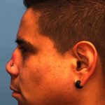 Rhinoplasty Before & After Patient #1005