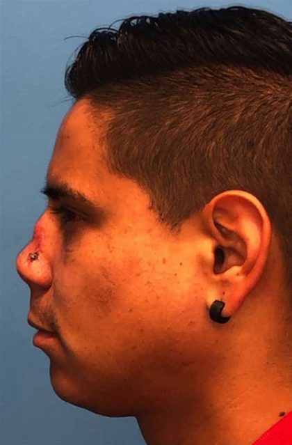 Rhinoplasty Before & After Patient #1005