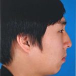 Rhinoplasty Before & After Patient #1023