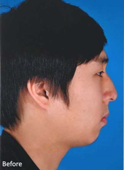 Rhinoplasty Before & After Patient #1023