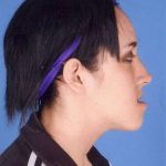 Jaw Surgery Before & After Patient #1161