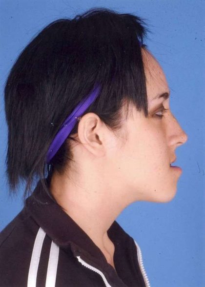 Jaw Surgery Before & After Patient #1161