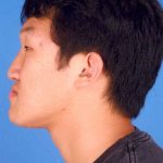 Jaw Surgery Before & After Patient #1155