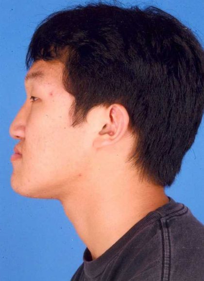 Jaw Surgery Before & After Patient #1155