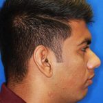 Jaw Surgery Before & After Patient #1149