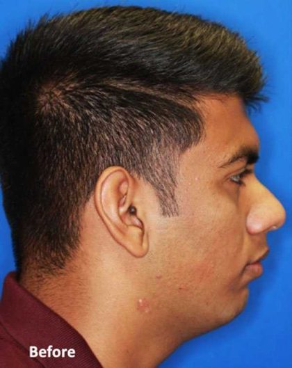 Jaw Surgery Before & After Patient #1149