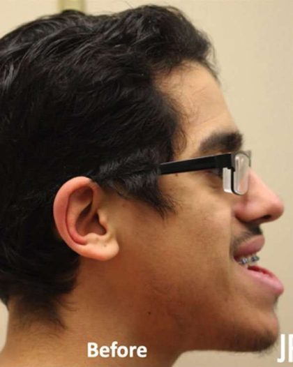 Jaw Surgery Before & After Patient #1137
