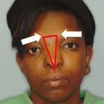 Craniofacial Before & After Patient #1188