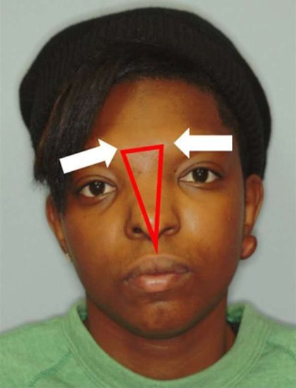 Craniofacial Before & After Patient #1188