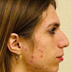 Facial Feminization Before & After Patient #900