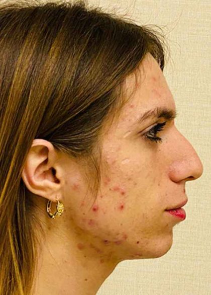 Facial Feminization Before & After Patient #900