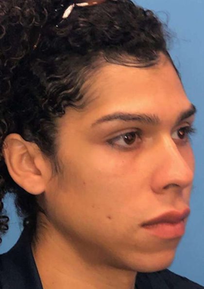 Facial Feminization Before & After Patient #924