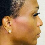 Facial Feminization Before & After Patient #894