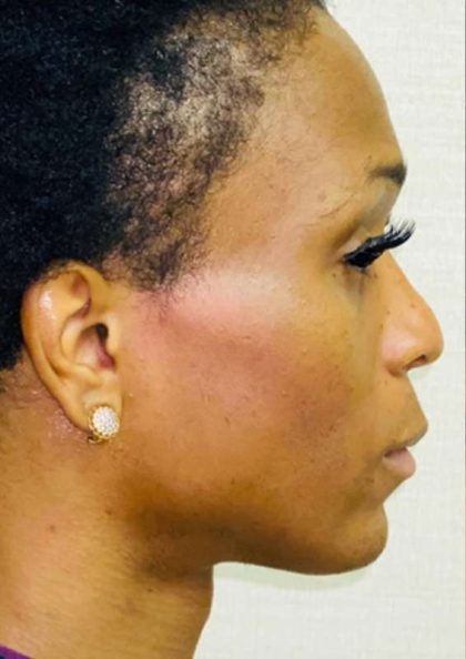 Facial Feminization Before & After Patient #894