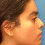 Facial Feminization Before & After Patient #882