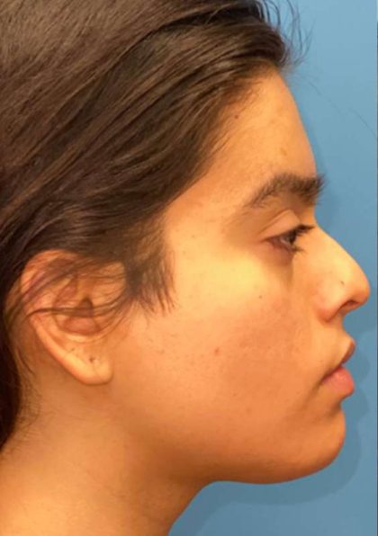 Facial Feminization Before & After Patient #882