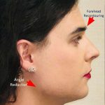 Facial Feminization Before & After Patient #876