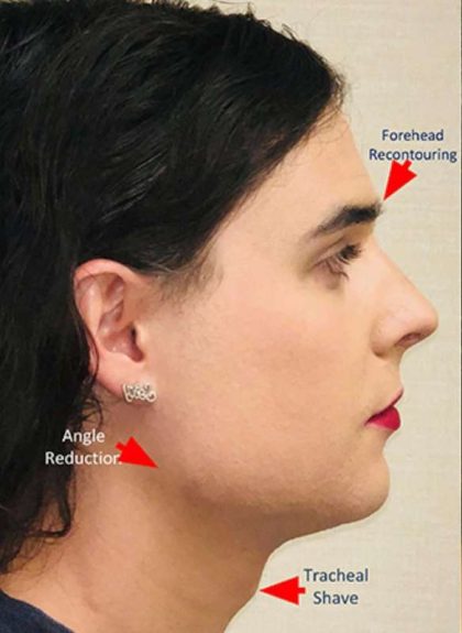 Facial Feminization Before & After Patient #876