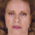 Facelift Before & After Patient #999