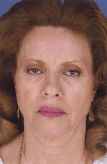 Facelift Before & After Patient #999