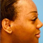Facial Feminization Before & After Patient #918