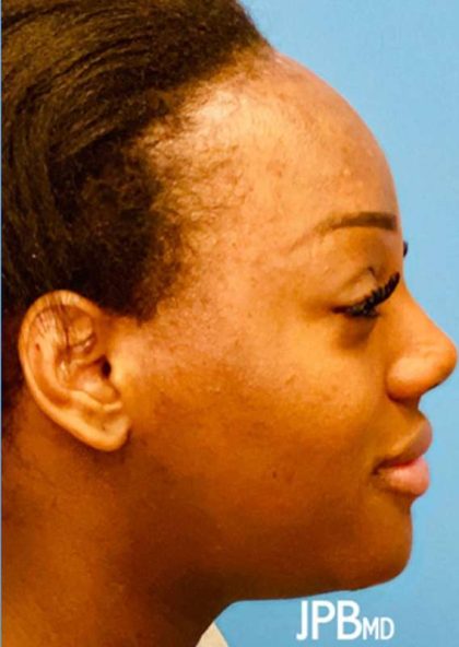 Facial Feminization Before & After Patient #918