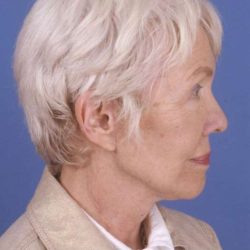Facelift Before & After Patient #993