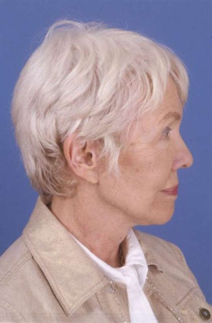 Facelift Before & After Patient #993