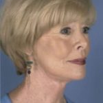 Facelift Before & After Patient #987