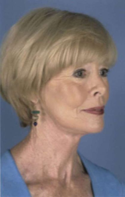 Facelift Before & After Patient #987