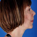 Facelift Before & After Patient #975