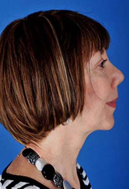 Facelift Before & After Patient #975