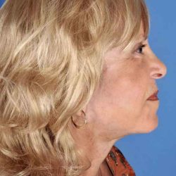 Facelift Before & After Patient #969